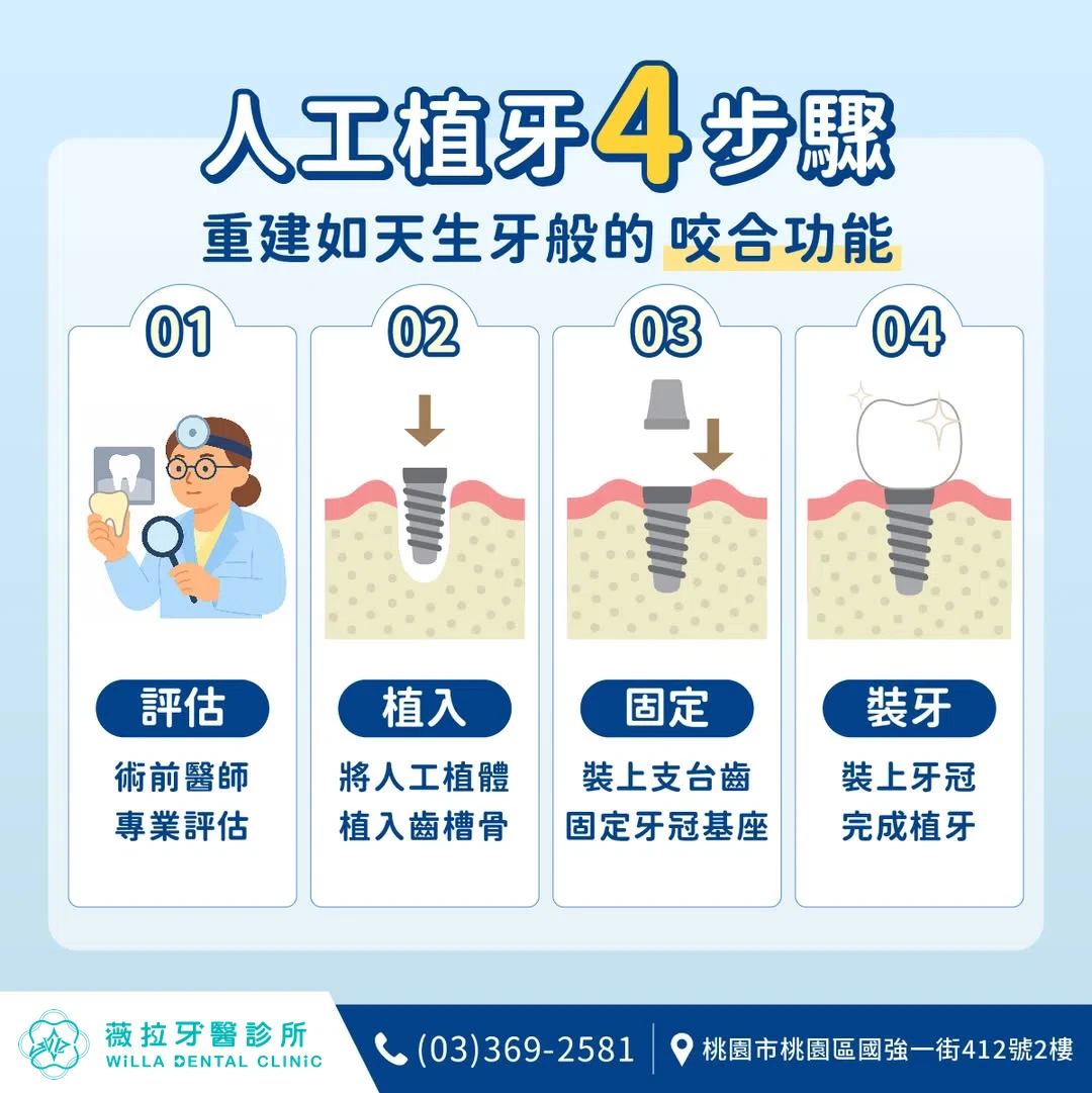 數位舒眠微創植牙【一顆4.3萬元】 數位舒眠微創植牙【一顆4.3萬元】